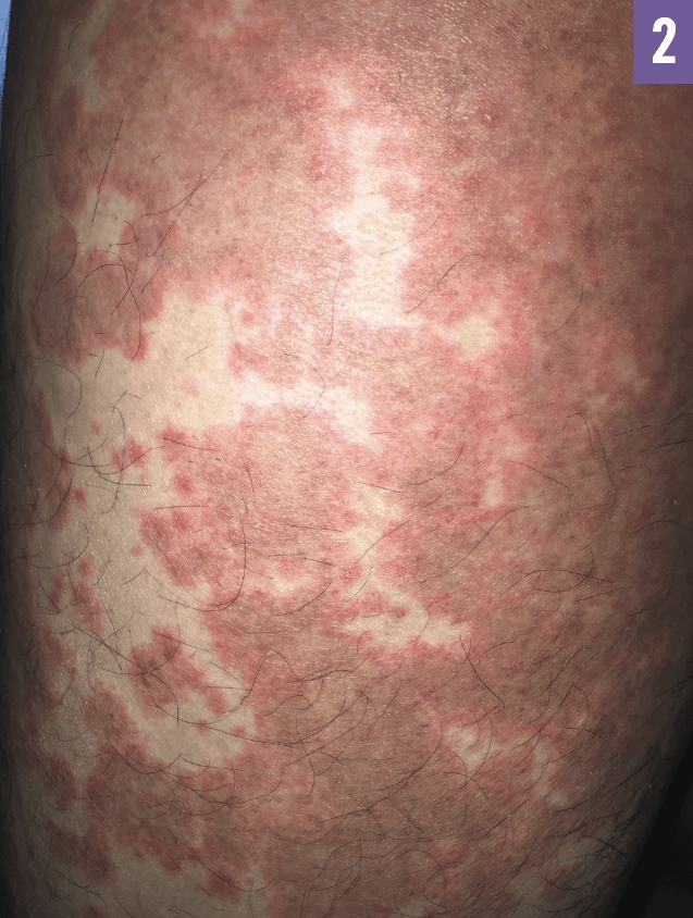 Prednisone For Hives Treatment